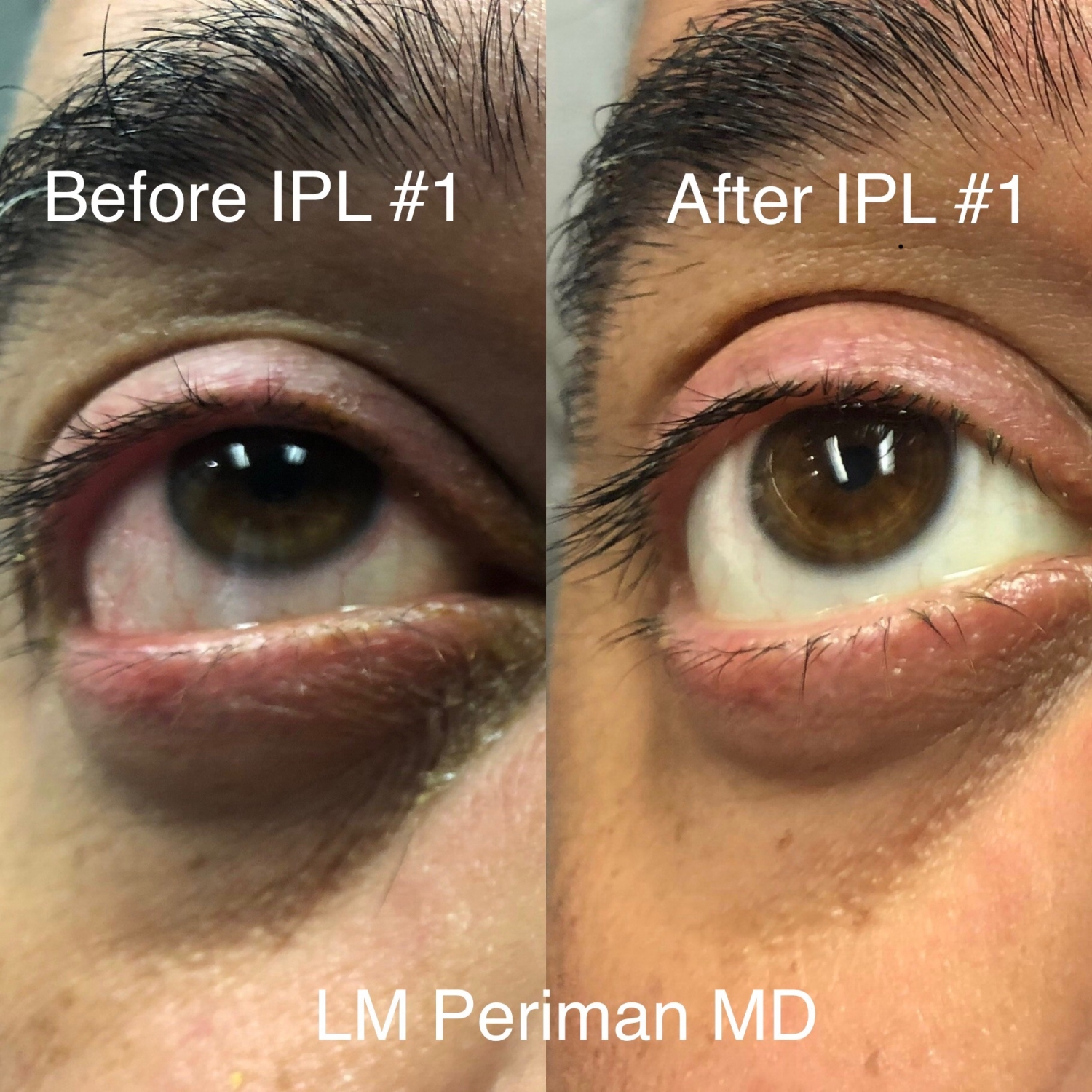 Is Ipl For Dry Eyes Covered By Insurance - Cmea