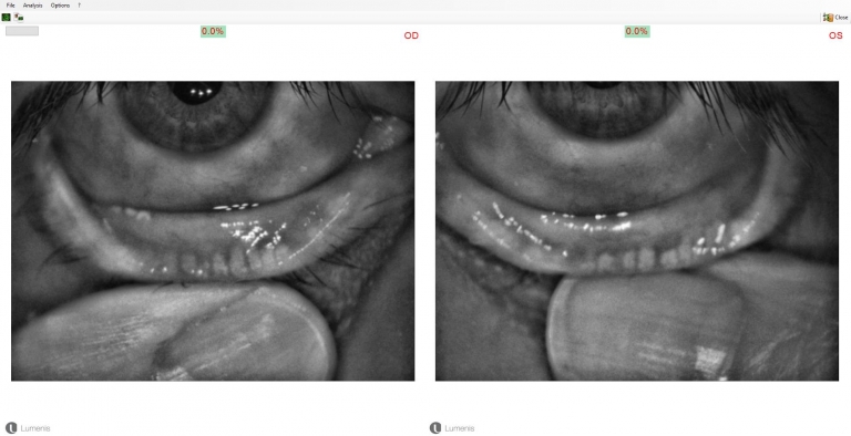 Meibomian Gland Dysfunction - Dry Eye Master