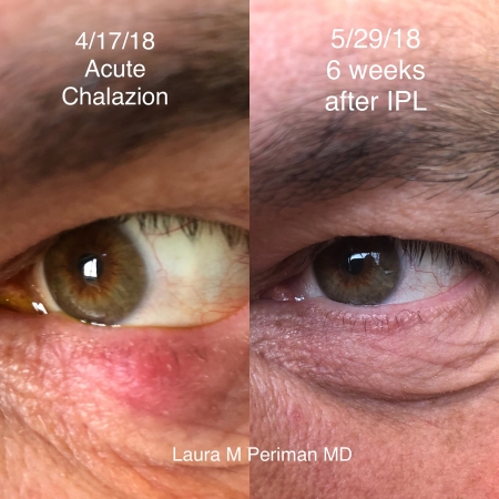 2 Acute Chalazion IPL - Dry Eye Master