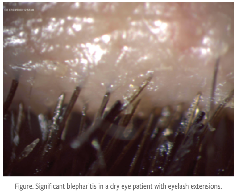 blepharitiseyelashextensions Dry Eye Master