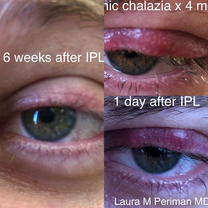 3 Chalazion IPL Dry Eye Master