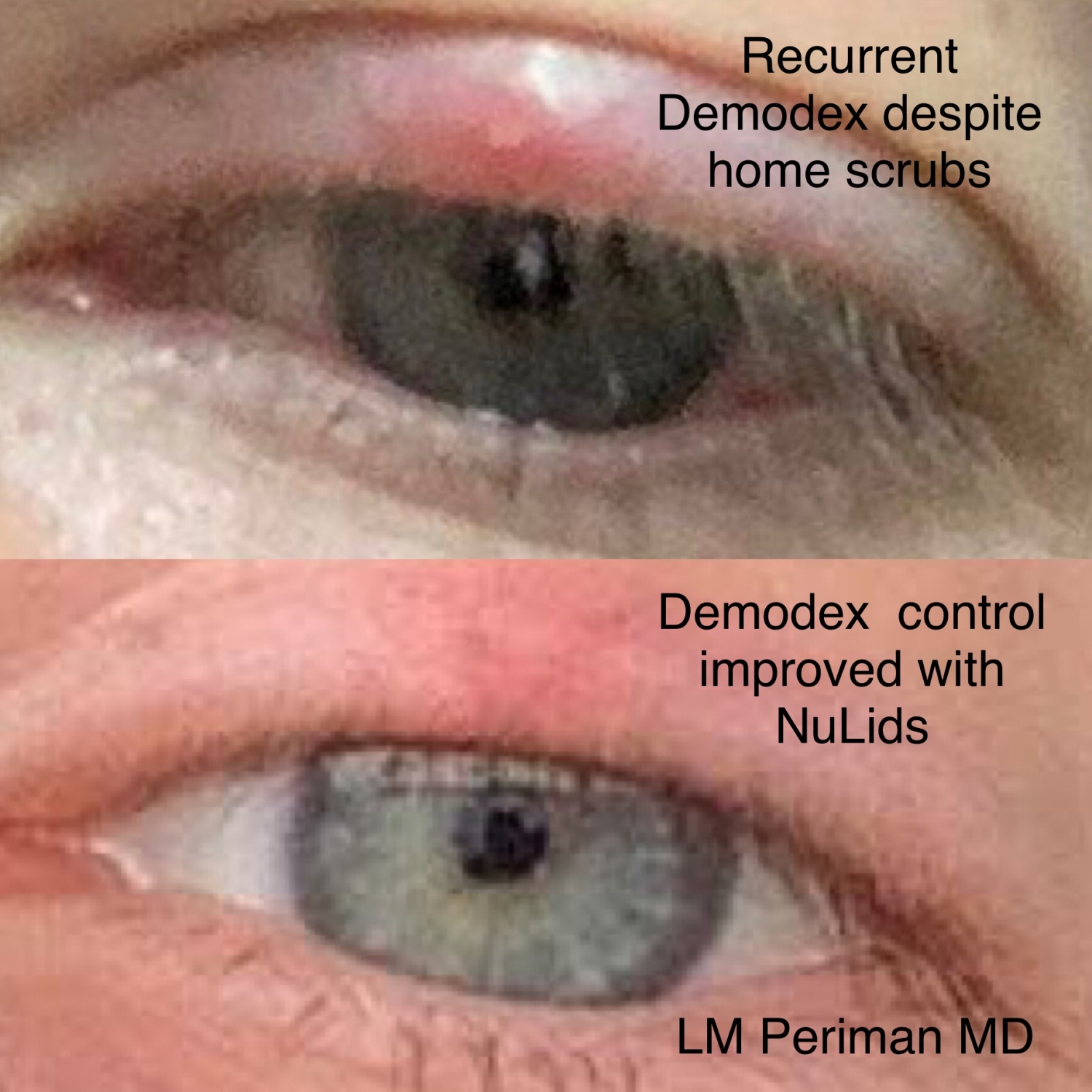 demodexlidscrubsnulids Dry Eye Master