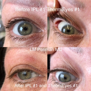 2 Eyelid Laxity IPL RF