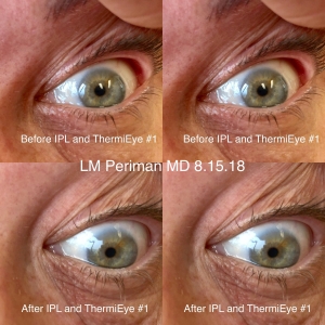 Eyelid Laxity IPL RF