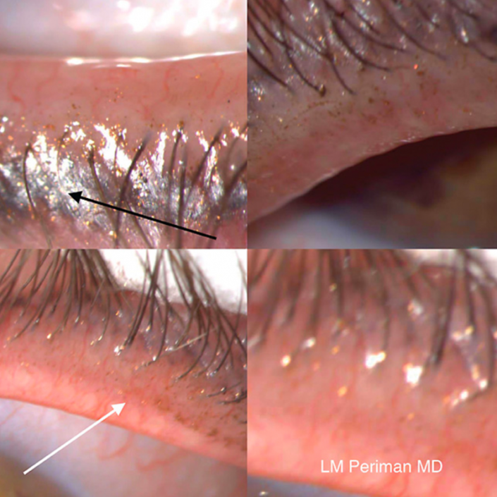 Drops & Eyelash Cosmetics with Laura M. Periman, MD