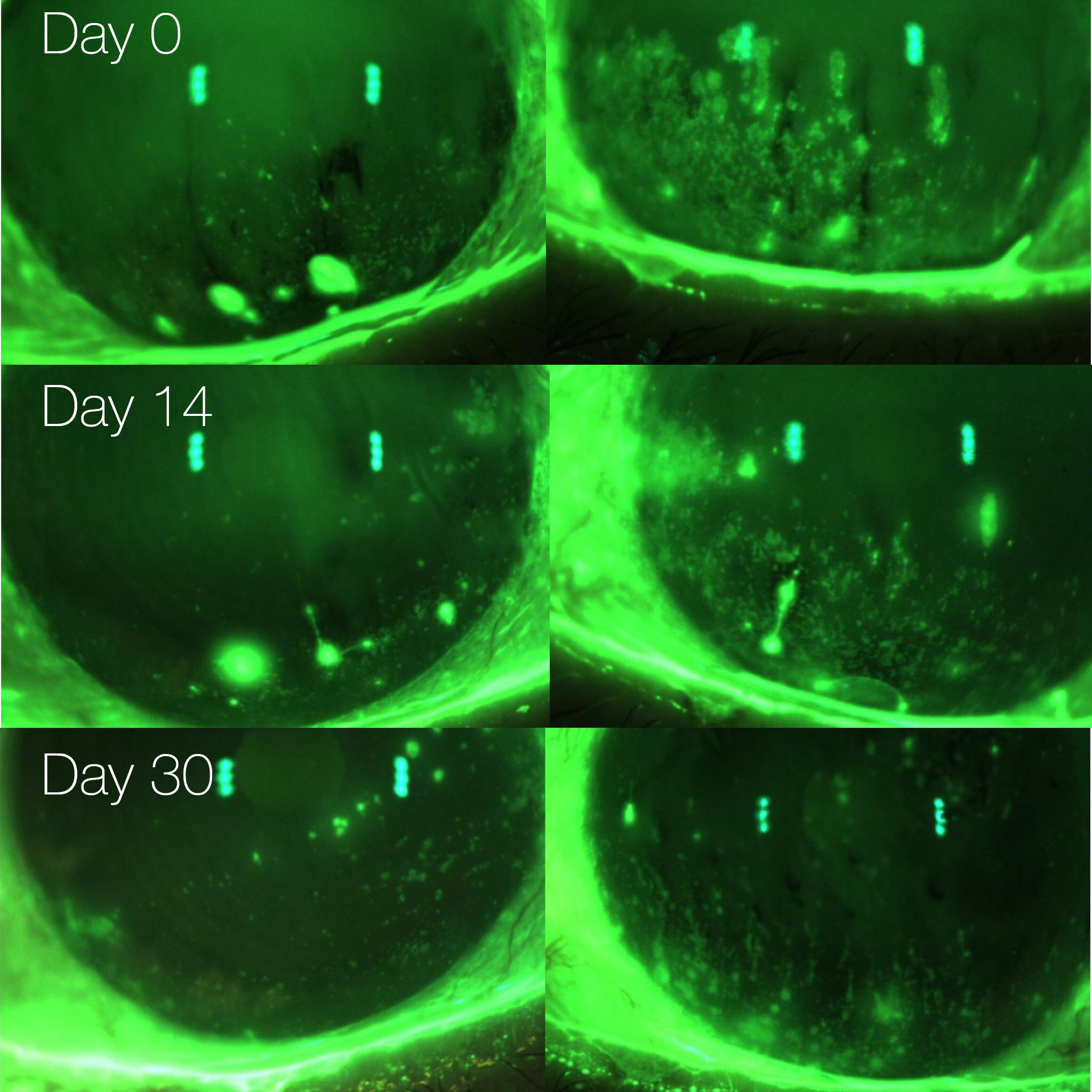 Superficial Punctate Keratitis