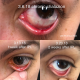 Stye - Chalazion - Hordeolum by Ophthalmologist Laura Periman, MD